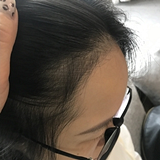 3个月长出了发际线