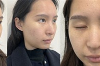 这些皮肤项目真有效,一次就光滑透亮,毛孔变小