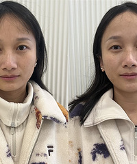 做一次黑金超光子相当于做三次普通光子嫩肤!更白更嫩,还能淡斑