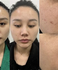 舒适度更高的“抗衰神器”真能缩毛孔