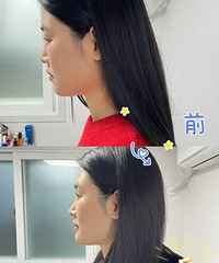 侧脸轮廓清晰后,人看起更加精致!这两个项目搭配做,效果更棒