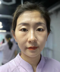 热玛吉做了3个月,说说真实感受!松垮的脸一下子就变紧实了