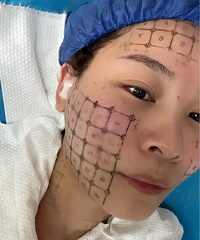 过年的自信是热玛吉给的,才做了15天,效果就这么好了