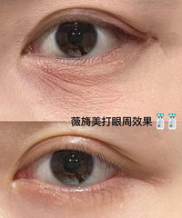 无滤镜真实记录我的眼周变化,做了这个之后,细纹都几乎没了