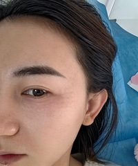 无滤镜真实记录我的眼周变化,做了这个之后,细纹都几乎没了