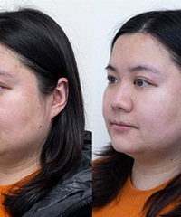 抗衰界“黑马”一次就改善4个面部问题