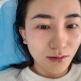 无P图记录眼周变化