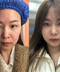 做完热玛吉15天,看看效果如何