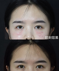 泪沟凹陷、黑眼圈、眼周细纹,我找到了解决办法