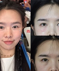 我找到了解决眼纹,泪沟,黑眼圈的方法