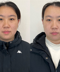 做一次黄金超光子全模式,皮肤能有怎样的改变!居然能白这么多