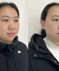 做一次黄金超光子全模式,皮肤能有怎样的改变!居然能白这么多