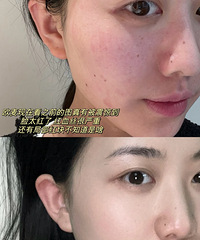 说实话!做了6次黄金超光子,皮肤越来越好,钱总算没白花