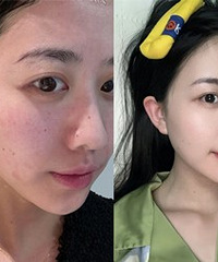 做了6次光子嫩肤,皮肤越来越好