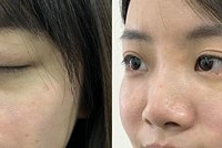 这个方法超快解决了我的泪沟和黑眼圈