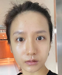 换季皮肤过敏,做了超光子全模式,肤质都改善了