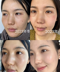 长了8年斑,做了2次超皮秒,就淡化了这么!现在皮肤真的好