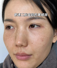 长了8年斑,做了2次超皮秒,就淡化了这么!现在皮肤真的好
