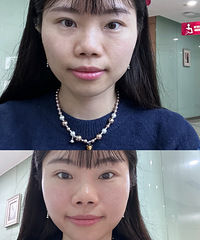 几百块的抗衰项目,效果也真好
