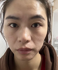 看了那么多抗衰项目,还是选了热玛吉,果然一分钱一分货