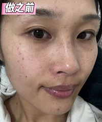 办了祛斑年卡,真的太划算了,现在脸恢复得白白净净