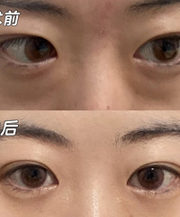 做了祛眼袋手术,20天之后变化真心大!仿佛年轻10岁
