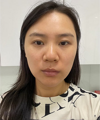你也纠结热玛吉还是超声炮吗?看看我的变化,给你做参考