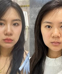 纠结热玛吉还是超声炮?可以先看看我