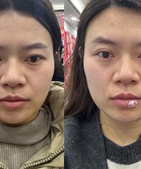 抗衰项目我超爱热玛吉,要做就做最好的