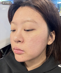 做水光之后,真能看到很明显的效果,4天就又白又嫩了