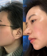 双下巴没了,下颌线还超级清晰了