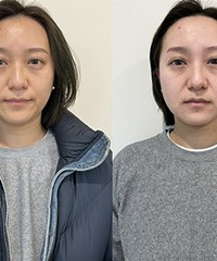 超光子+双重水光,我的肤色白了3倍
