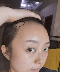 用了4个月的时间,我的发际线终于长出来了!来看看变化