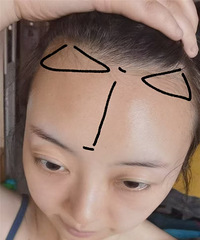 用了4个月的时间,我的发际线终于长出来了!来看看变化