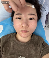 尝试了能够真正缩小毛孔的黄金微针第五代,记录每天的皮肤变化