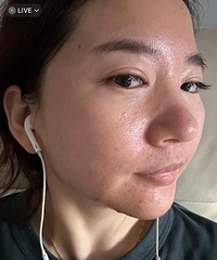 新尝试了黄金微针第五代,皮肤看起干净多了