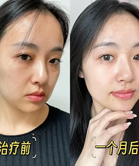 做完黄金超声炮一个月了,紧致提升很明显,法令纹都快没了