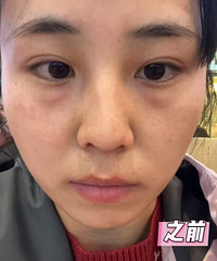 终于祛掉了20多年的大眼袋和泪沟,感觉自己一下子就变年轻了