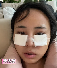 终于祛掉了20多年的大眼袋和泪沟,感觉自己一下子就变年轻了