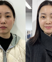 祛斑其实很简单!这3个项目一起做,一次就能让脸变干净N倍