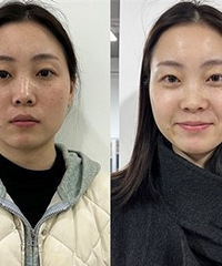 做了这3个项目,脸上的斑变干净了N倍