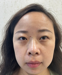 没有了眼袋,泪沟和黑眼圈,都说我看起来年轻了起码10岁