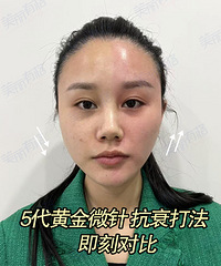 30岁抗衰就算黄金微针5代,缩毛孔,改善肤质,还比4代体验感