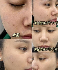 30岁抗衰就算黄金微针5代,缩毛孔,改善肤质,还比4代体验感