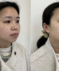 超光子+水光,简直是妥妥的神仙搭配!肤质更细腻,肤色也白3倍