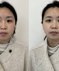超光子+水光,简直是妥妥的神仙搭配!肤质更细腻,肤色也白3倍