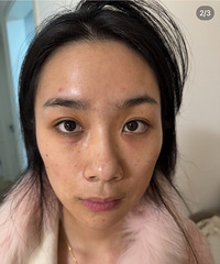 这个方法对付泪沟凹陷,真的太有效了!看起来年轻好几岁
