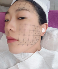 做了热玛吉之后,我觉得我现在的脸也太瘦了吧!后悔没早做