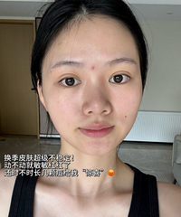 做水光改善痘痘和敏感肌,真的有效!现在皮肤超级稳定