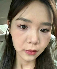 抗衰做超声炮简直太有性价比了,不到两千,就年轻这么多
